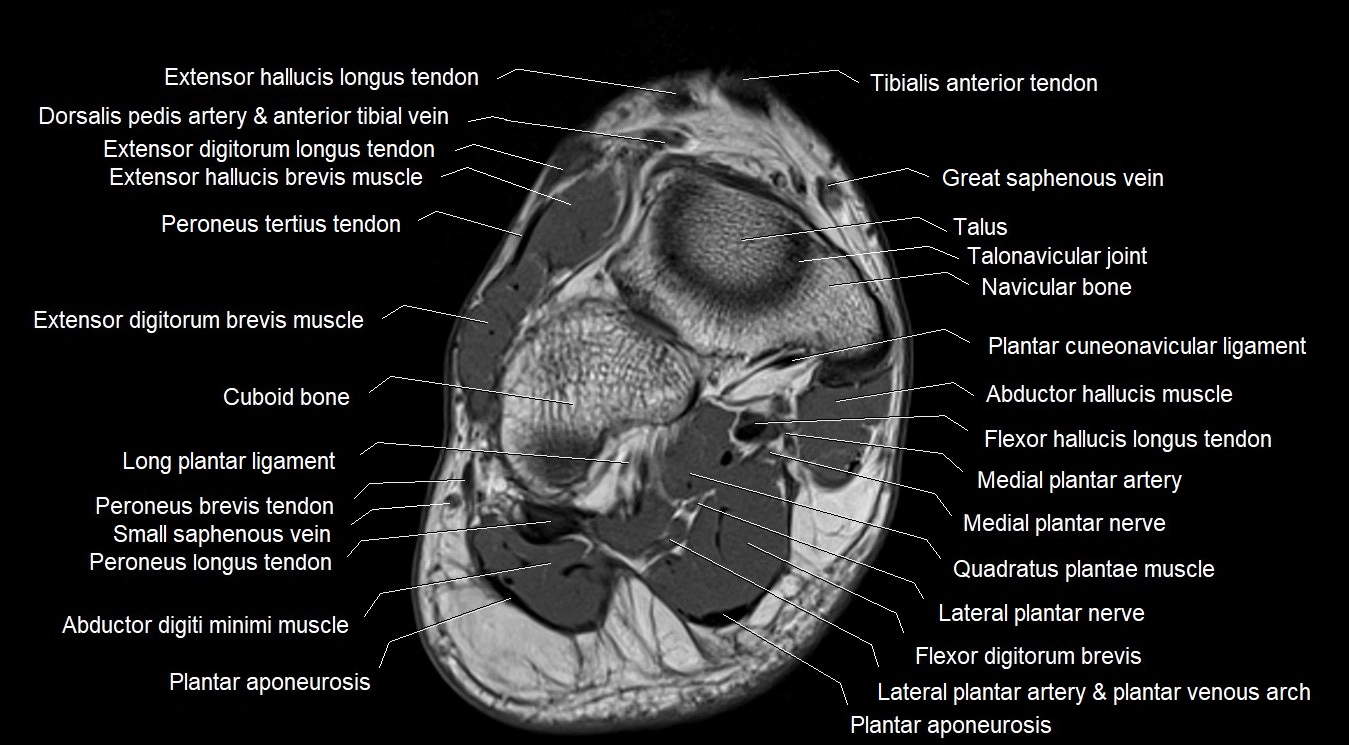 MRI 3T foot axial cross sectional anatomy image 3.webp